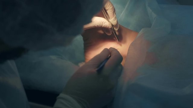 Surgeon makes an incision with scalpel on leg on ankle to remove joint hygroma in operating room in hospital. One day surgery concept. Operation in clinic. Surgical treatment of ankle hygroma.
