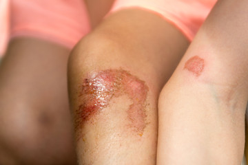 Wounds on the knee and the elbow of a small child. Bicycle accident. Selective focus.