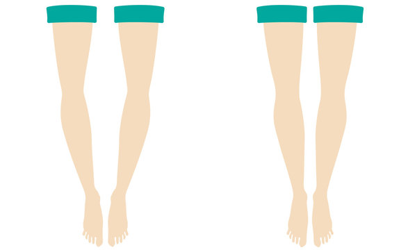 bow-legs and straight-legs illustration set