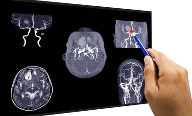 MRA AND MRV OF BRAIN:, presented with intracranial hemorrhage.This study was sent to evaluate intracranial vascular abnormality at bilateral frontal lobes.Medical concept.