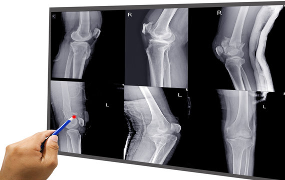 Knee joint x-ray collection fracture different views.