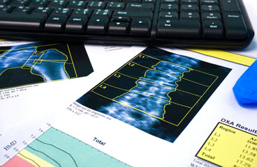 Close up Bone Densitometry Result on the table in room doctor.