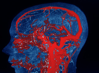 MRA AND MRV OF BRAIN Finding:Bilateral territorial muscles to the cortex and subcortical of the...