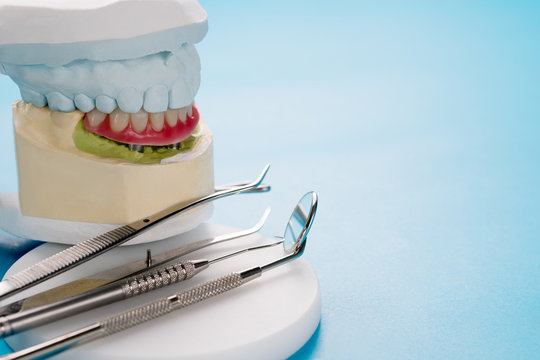 Closeup/ Dental implants supported overdenture on blue background.