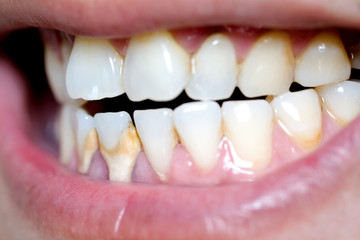 Tooth's a man smoking bad. Man smokes a cigarettes have tooth decay and calculus on teeth, So we should be care dental with the hygiene.