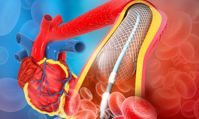 Human heart angioplasty. 3d illustration.