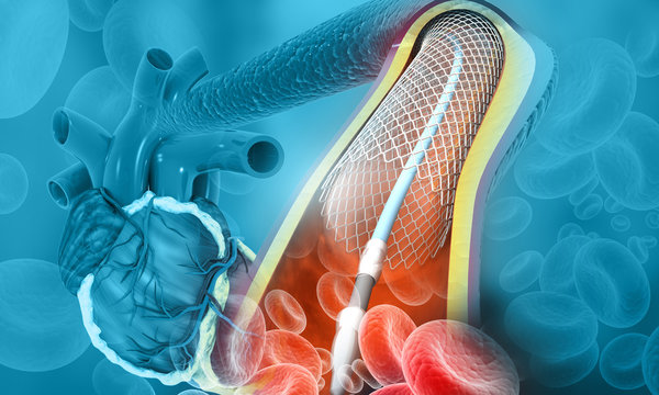 Human Heart Angioplasty. 3d Illustration