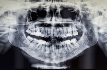Orthopantomography of an adult patient, dentistry
