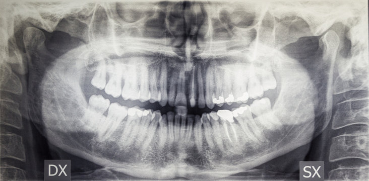 Orthopantomography of an adult patient, dentistry