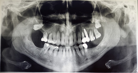 Orthopantomography of an adult patient, dentistry