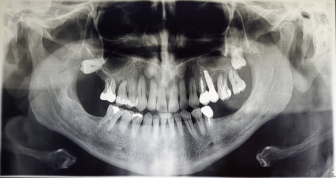 Orthopantomography of an adult patient, dentistry
