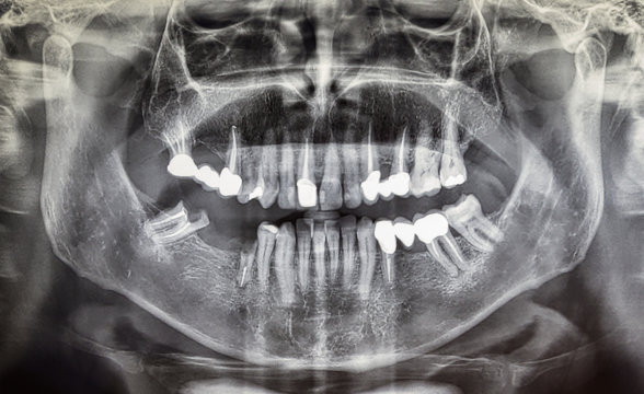 Orthopantomography of an adult patient, dentistry