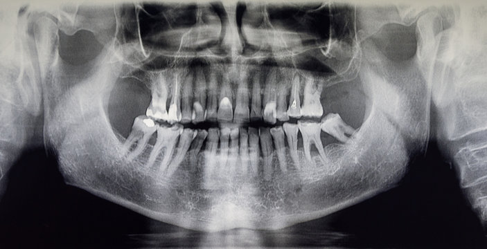 Orthopantomography of an adult patient, dentistry