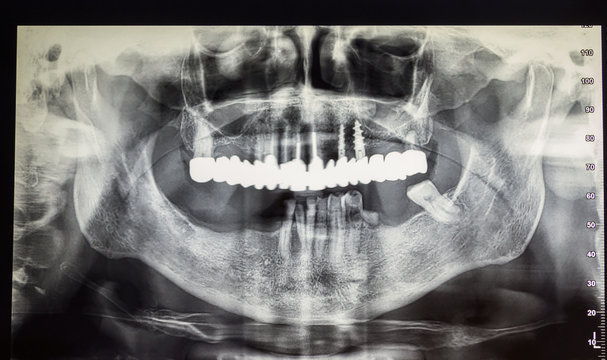 Orthopantomography of an adult patient, dentistry