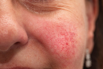An extreme closeup view on the cheek of a woman in her forties, a rosacea sufferer, with bright rosy red cheeks and visible superficial dilated blood vessels. - obrazy, fototapety, plakaty