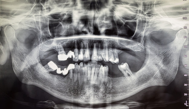 Orthopantomography of an adult patient, dentistry