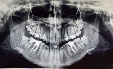 Orthopantomography of an adult patient, dentistry