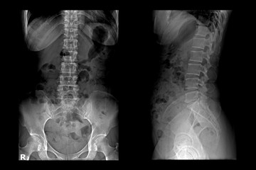 Two X-ray images of lumbar spine .Lumbar Degenerative Spinal Canal Stenosis or Herniated Nucleus Pulposus.  