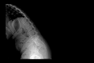 X-ray image of lumbar spine (Flex).Lumbar Degenerative Spinal Canal Stenosis or Herniated Nucleus...