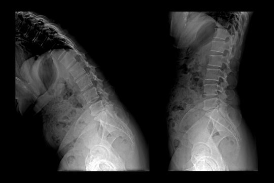 Two X-ray images of lumbar spine . Lumbar Degenerative Spinal Canal Stenosis or Herniated Nucleus Pulposus.