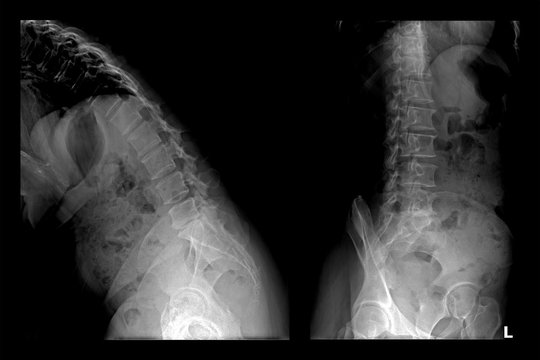 Two X-ray images of lumbar spine (Flex and left). Lumbar Degenerative Spinal Canal Stenosis or Herniated Nucleus Pulposus.