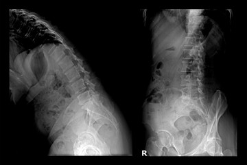 Two X-ray images of lumbar spine (Flex and right). Lumbar Degenerative Spinal Canal Stenosis or...