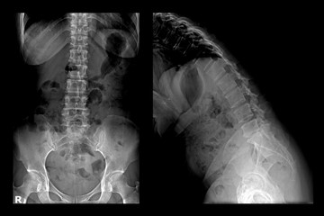 Two X-ray images of lumbar spine (front and flex).Lumbar Degenerative Spinal Canal Stenosis or Herniated Nucleus Pulposus.