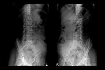 Two X-ray images of lumbar spine (left side and right side).Lumbar Degenerative Spinal Canal Stenosis or Herniated Nucleus Pulposus.
