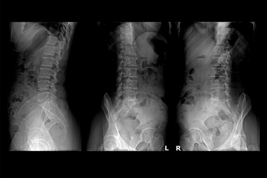Three x-ray images of lumbar spine.Lumbar Degenerative Spinal Canal Stenosis or Herniated Nucleus Pulposus.