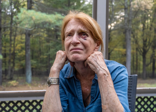 woman with black eye_3