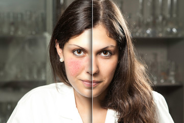 A before and after portrait of a professional woman who suffered from rosacea, resulting in rosy red cheeks, laser surgery gives a flawless complexion with confident smile.