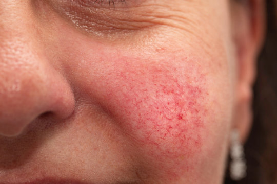 An extreme closeup view on the cheek of a woman in her forties, a rosacea sufferer, with bright rosy red cheeks and visible superficial dilated blood vessels.