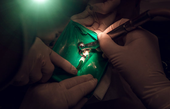 tdentistry. dental treatment, close-up. teeth and caries.