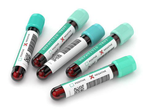 3d Render Of  Blood Samples With Hepatitis Test