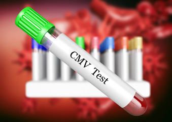 Blood sample in laboratory test tube for CMV (Cytomegalovirus) examination