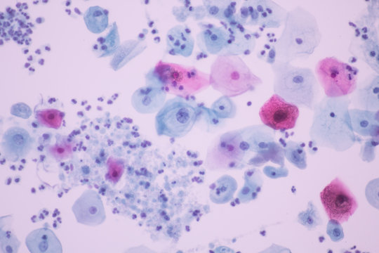 Trichomonas in pap smear on white background view in microscopic.Medical background.Cytology and pathology laboratory department.Sexually transmitted diseases.Magnification 600 X.