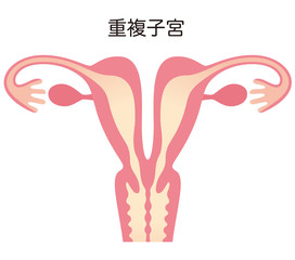 子宮奇形　重複子宮