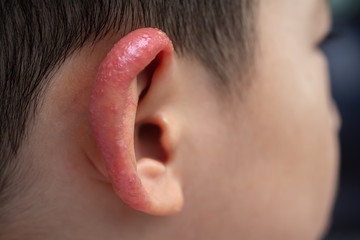 Close up child aurical (pinna) or external ear with inflamed skin from Atopic dermatitis. Selective...