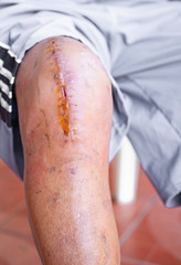 Photos of surgical wounds on the knees