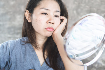 unhappy Asian woman checking her face skin problem with dark spot from scar acne 