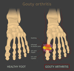 Gout arthritis image