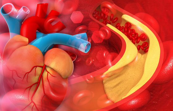Human heart artery blocked with cholesterol. 3d illustration