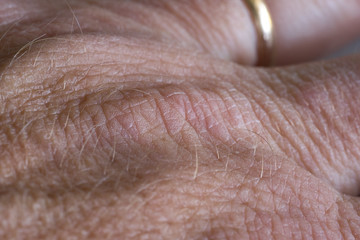 Fototapeta premium Foto Psoriasi