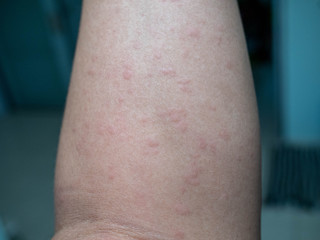 Fototapeta premium Rash on the skin