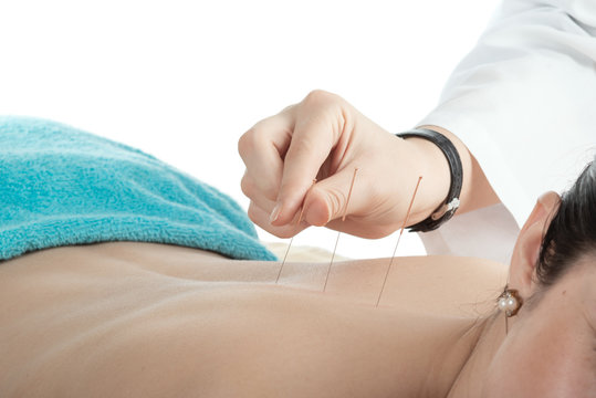 young woman on acupuncture treatment