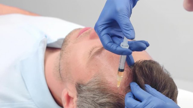 Close-up of Platelet Rich Plasma treatment for hair rejuvenation