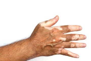 Vitiligo on spreading hand on white isolated background