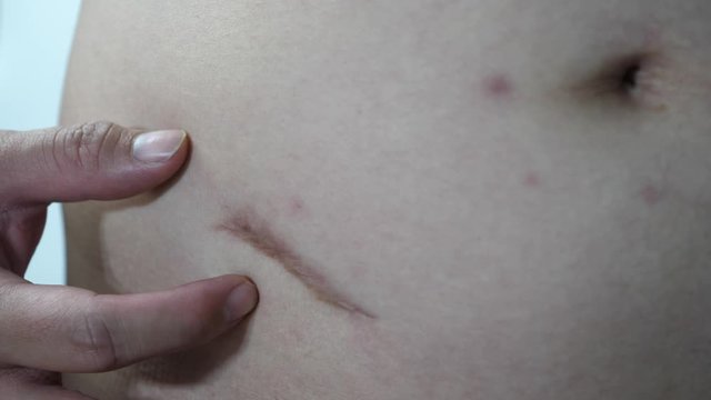 Scar of a man caused by an appendicitis surgery.