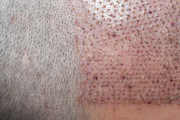 Close up hair graft transplantation with follicular unit extraction (FUE). Bald head of hair loss...