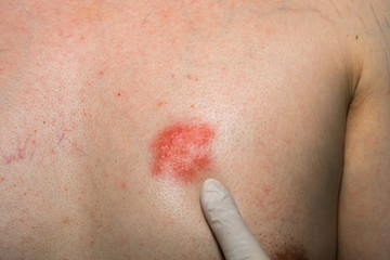 Doctor wear a glove and pointing to Herpes zoster at chest. Detail of skin infected.